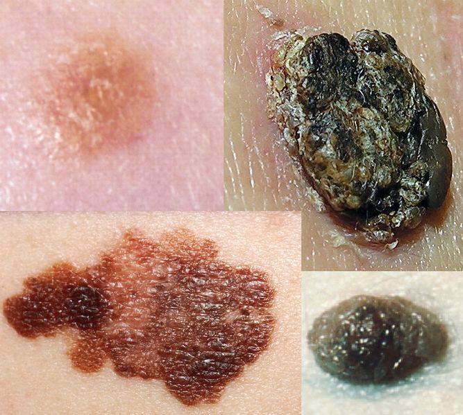 File:Dark skin focalities.jpg