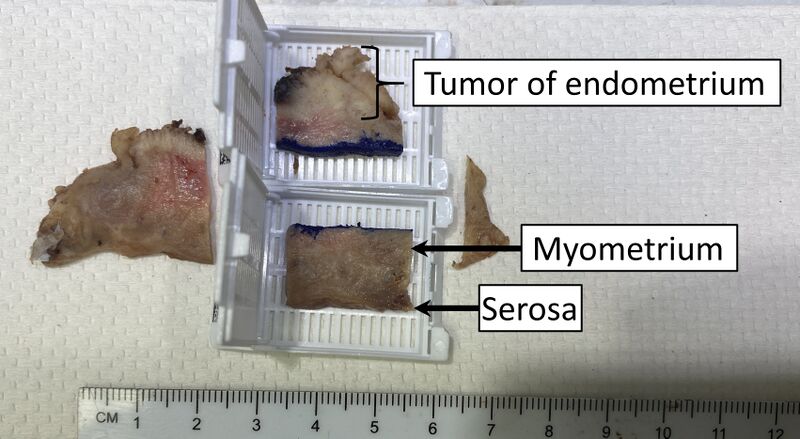 File:Tumor to serosa slices.jpg