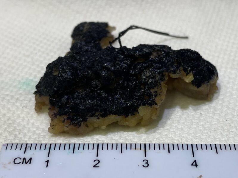 File:Gross pathology of breast re-excision.jpg