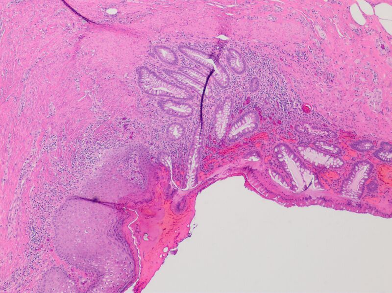 File:Colostomy stoma junction with inflammation.jpg