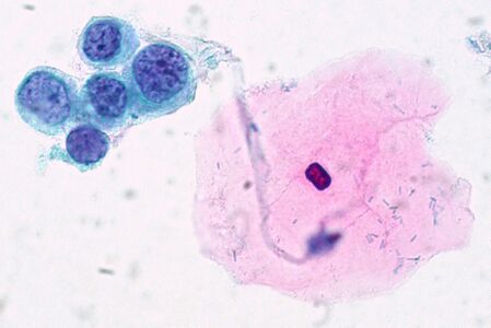 High-grade squamous intraepithelial lesion (HSIL), showing even more prominent features, and decreased cytoplasm, causing a high nuclear/cytoplasmic ratio.