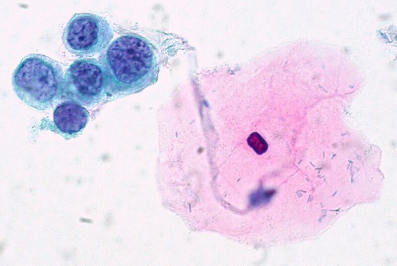 File:Cytology of High-Grade SIL, ThinPrep.jpg