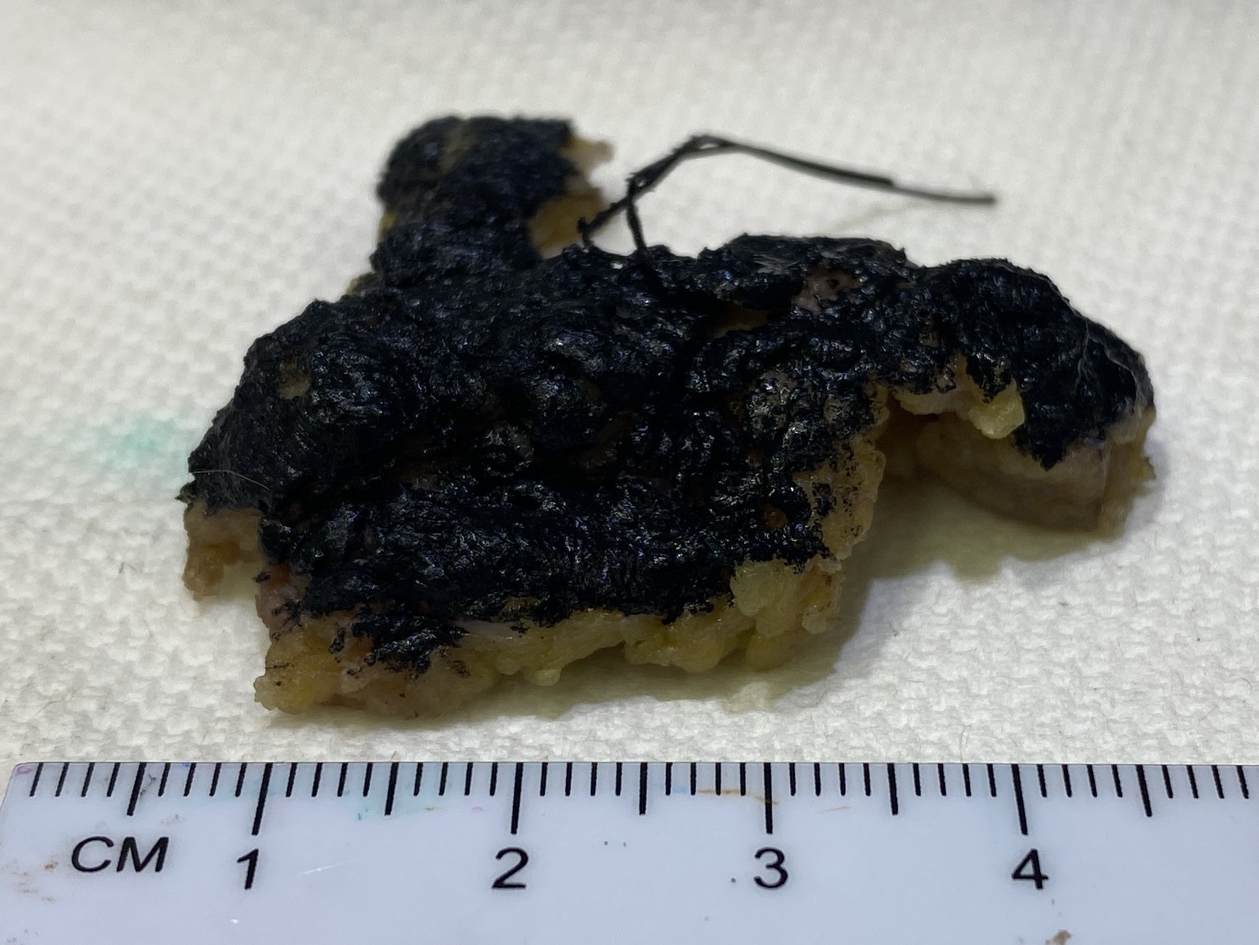 For breast re-excisions, ink the new margin (in this case marked with a suture).