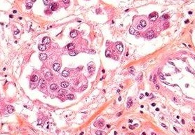 If unsure whether a case is true lymphovascular invasion or a retraction artifact (imaged), use immunohistochemistry for D2-40 to highlight lymphatic vessels or CD-31 for blood vessels.