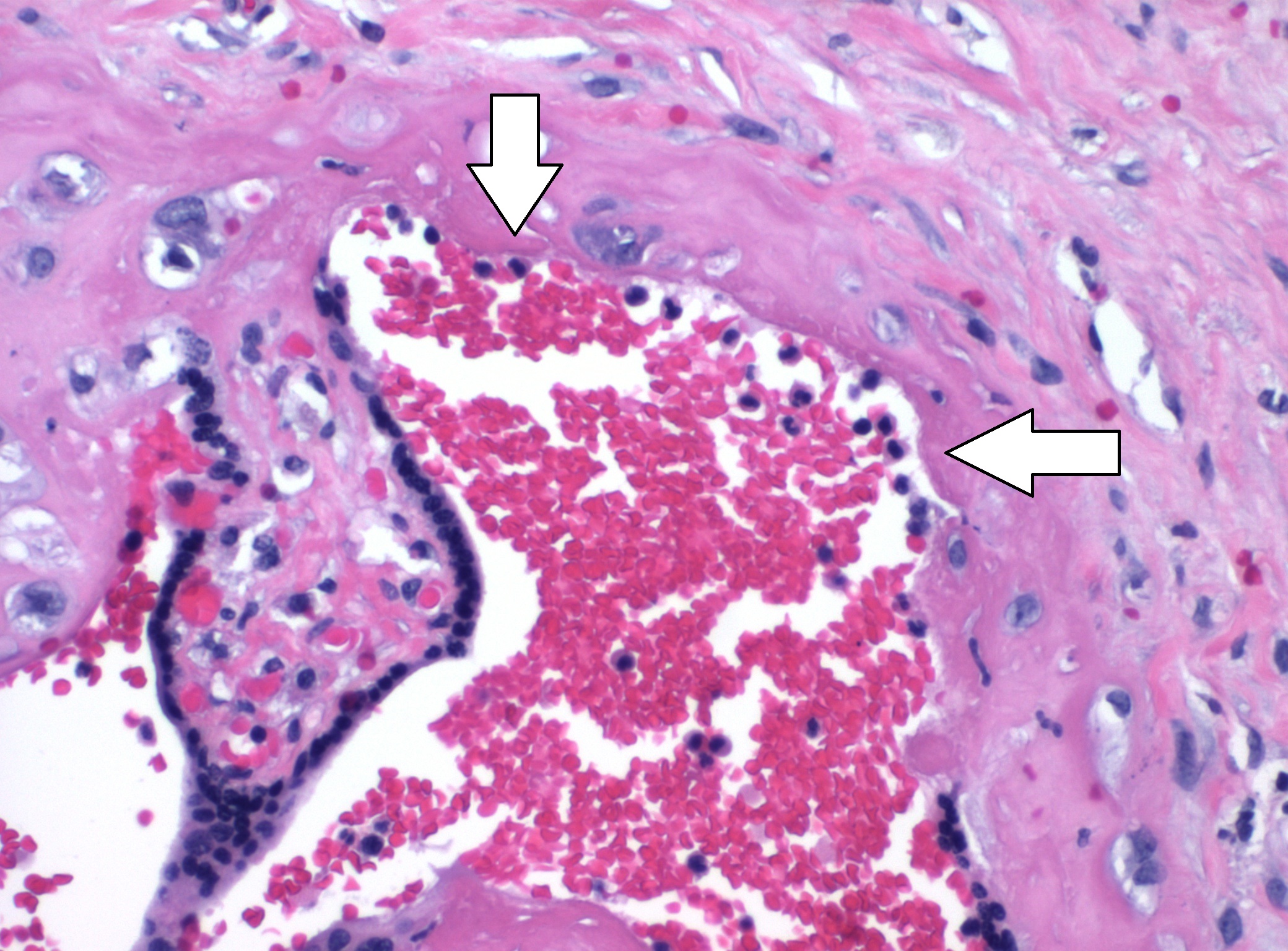 On the other hand, a small amount of intervillous neutrophils by the fetal surface like this is insignificant.